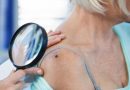 Estudo da USP abre novas perspectivas para o tratamento do tipo mais letal de câncer de pele